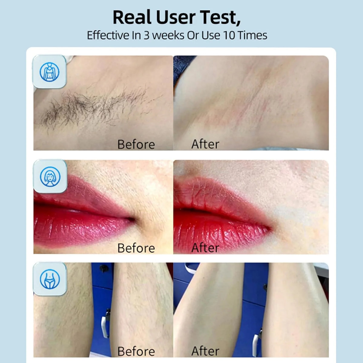 MLAY T14 IPL Hair Removal Device (جهاز إزالة الشعر) – Ice Cooling Home Laser Hair Remover